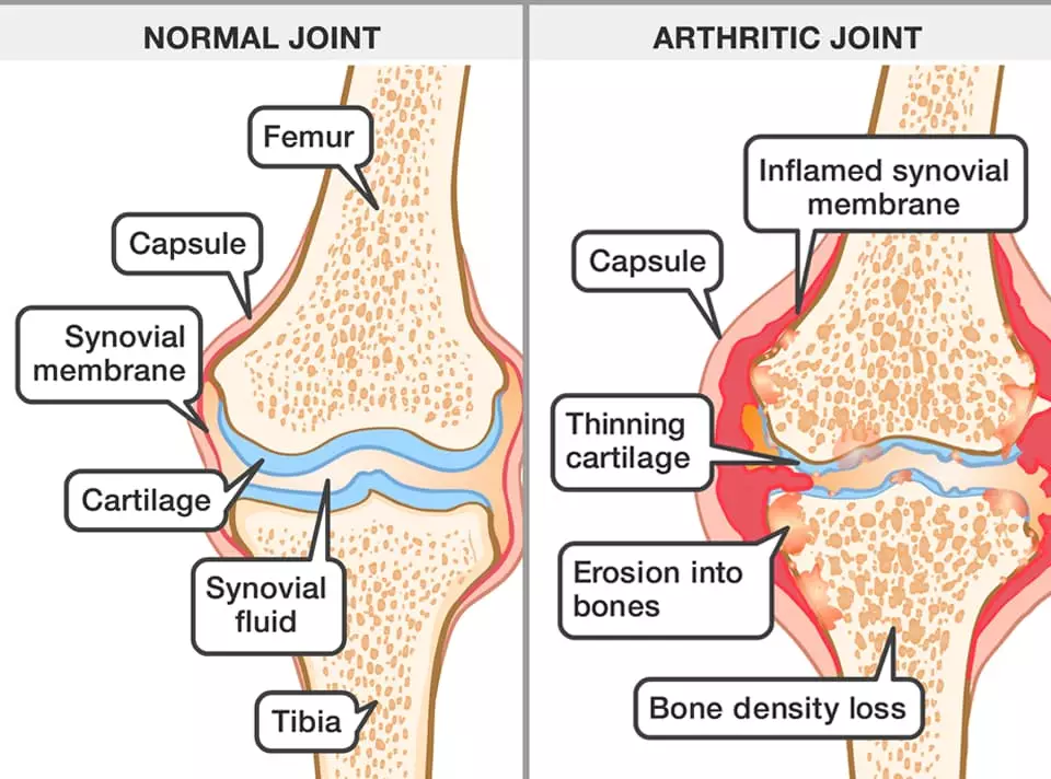 joint-pain-2-3rd